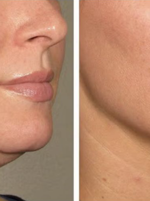 Anti Aging/Skin Tightening